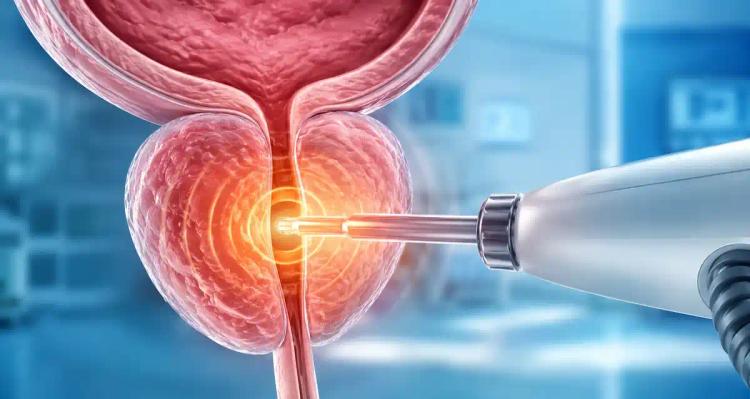 Heat-Based Prostate Care and Male Fertility Planning